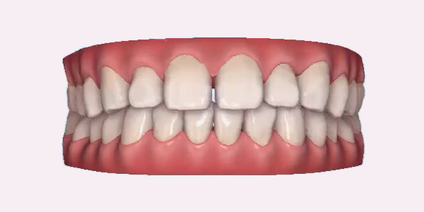 Gapped Teeth
