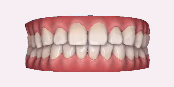 Gapped Teeth