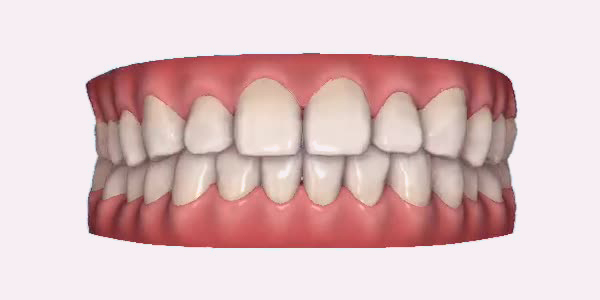 Gapped Teeth