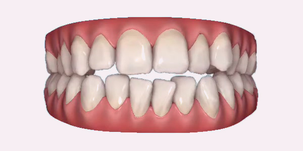 Open Bite