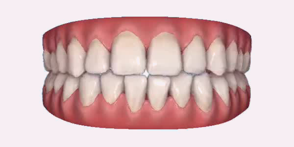 Open Bite