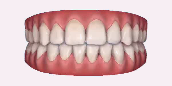 Open Bite